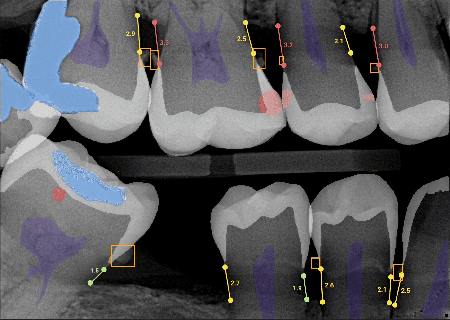All findings with Overjet x-rays All findings with Overjet x-rays